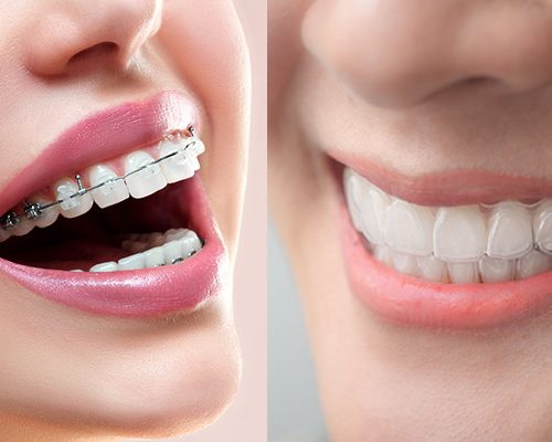 Diferencias-entre-la-ortodoncia-tradicional-y-la-ortodoncia-invisible